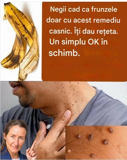 Negii cad ca frunzele doar cu acest remediu casnic. Îți dau rețeta.