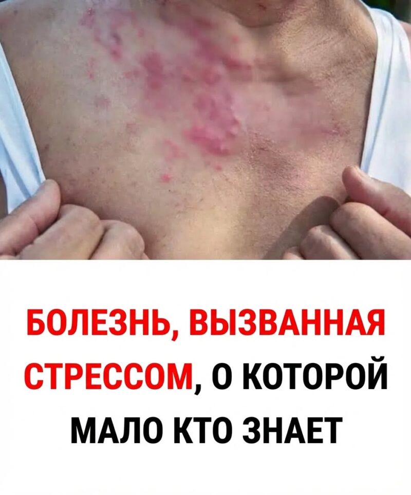 Похоже, что резкое снижение иммунной защиты, возможно, связанное с сильным психофизическим стрессом, может способствовать реактивации вируса.