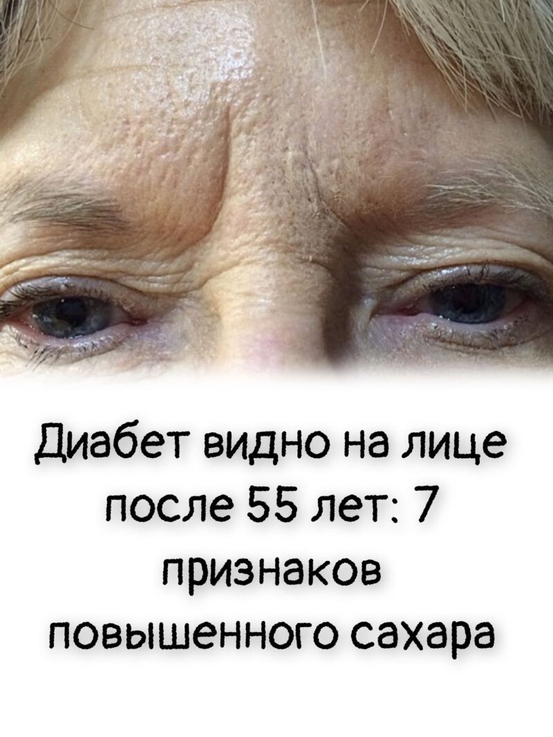 Диабет видно на лице после 55 лет: 7 признаков повышенного сахара 