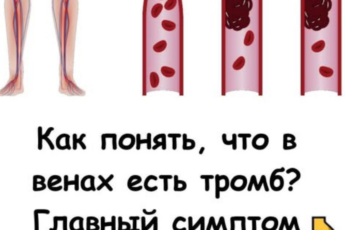 Как понять, что в венах есть тромб Называю главный симптом
