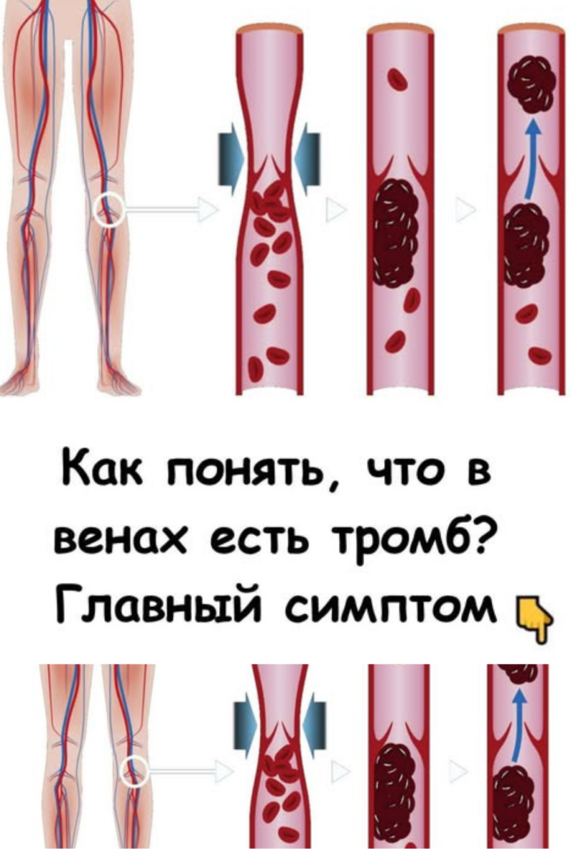 Как понять, что в венах есть тромб Называю главный симптом