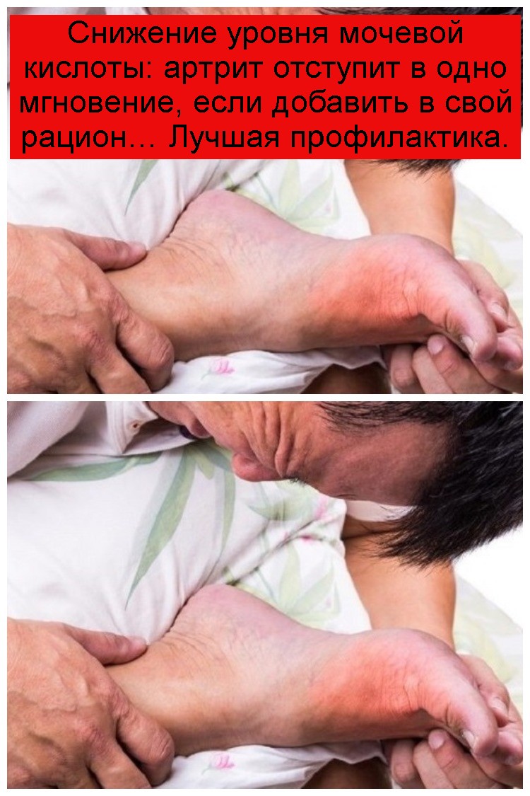 Снижение уровня мочевой кислоты: артрит отступит в одно мгновение, если добавить в свой рацион… Лучшая профилактика.