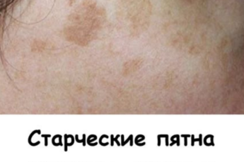 Старческие пятна ИСЧЕЗЛИ, когда я добавила в рацион эти 4 простых продукта.