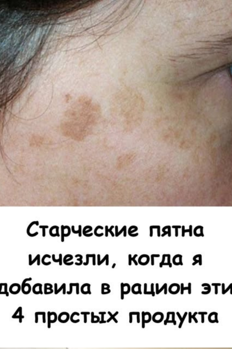 Старческие пятна ИСЧЕЗЛИ, когда я добавила в рацион эти 4 простых продукта.