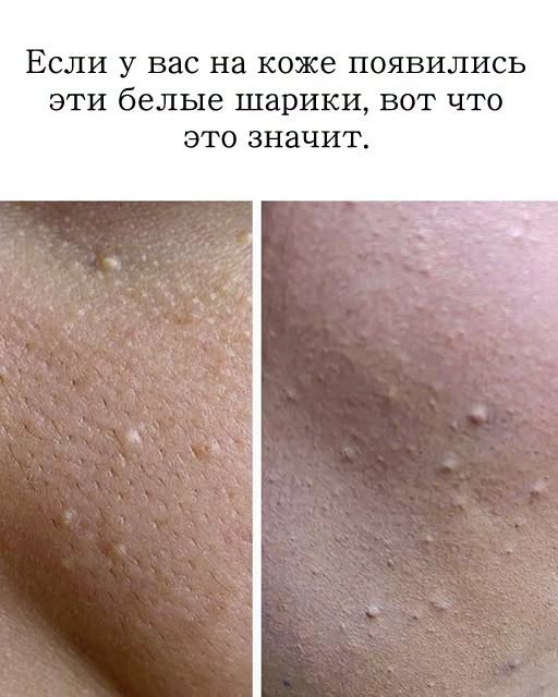 Если у вас на коже белые шарики, это означает, что… Читайте далее.