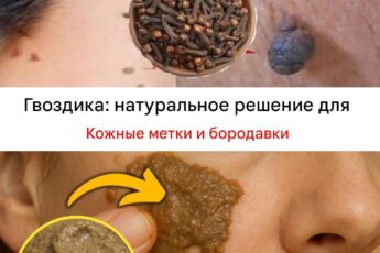 Как свести бородавки и папилломы народными средствами