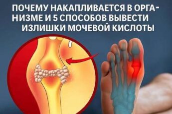 Главный враг суставов - мочевая кислота. Почему накапливается в организме и 5 способов вывести излишки мочевой кислоты
