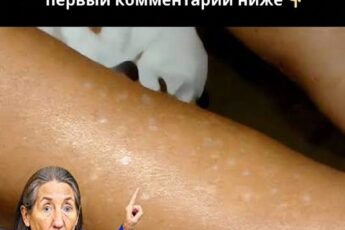 Вы замечали маленькие белые пятна на руках или ногах... а ты не знаешь что это такое? Вот что говорит специалист, проверьте 1 комментарий