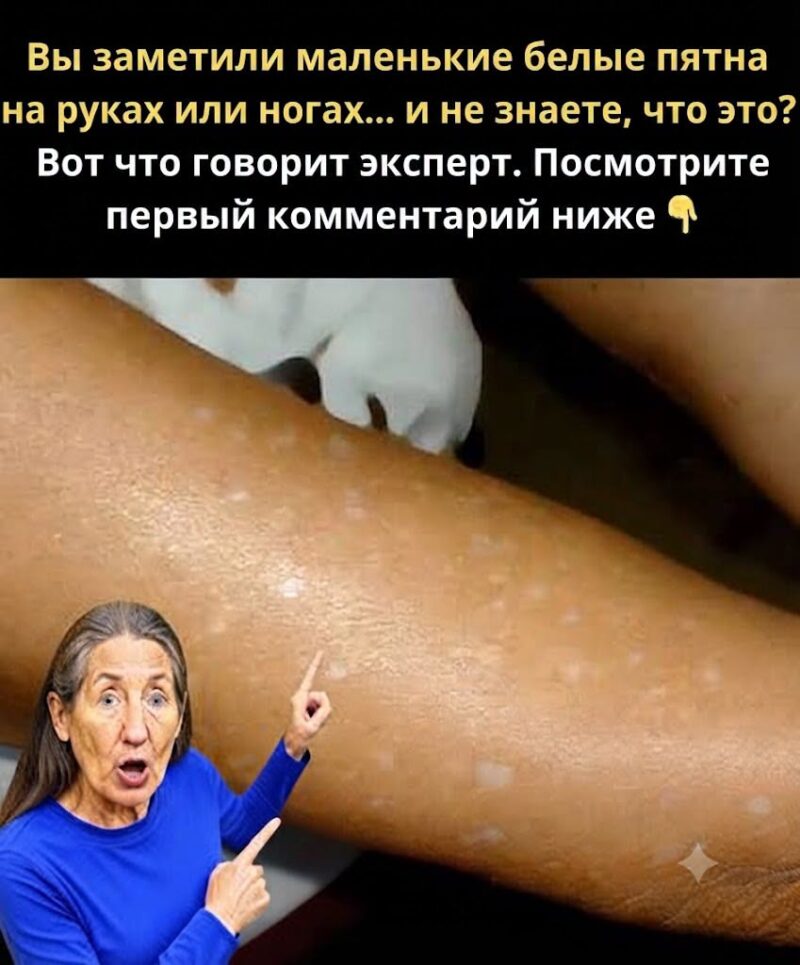 Вы замечали маленькие белые пятна на руках или ногах... а ты не знаешь что это такое? Вот что говорит специалист, проверьте 1 комментарий