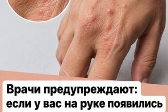 Врачи предупреждают: если вы заметили на руке или кисти эти маленькие красные точки, не игнорируйте тревожные сигналы