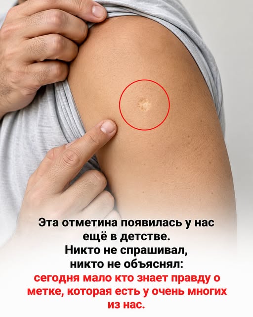 Что на самом деле скрывается за загадочным круглым шрамом на плече