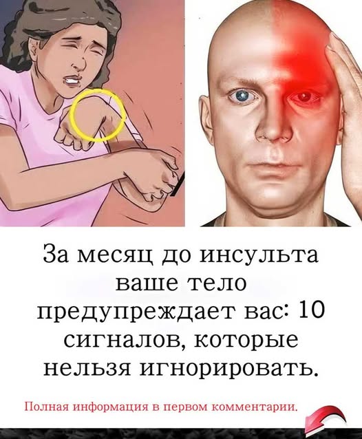 Врачи предупреждают: инсульт начинается за 30 дней, но мало кто это понимает